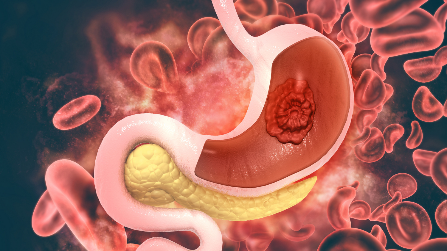 Gas in Stomach Explained - Causes, Symptoms & Remedies