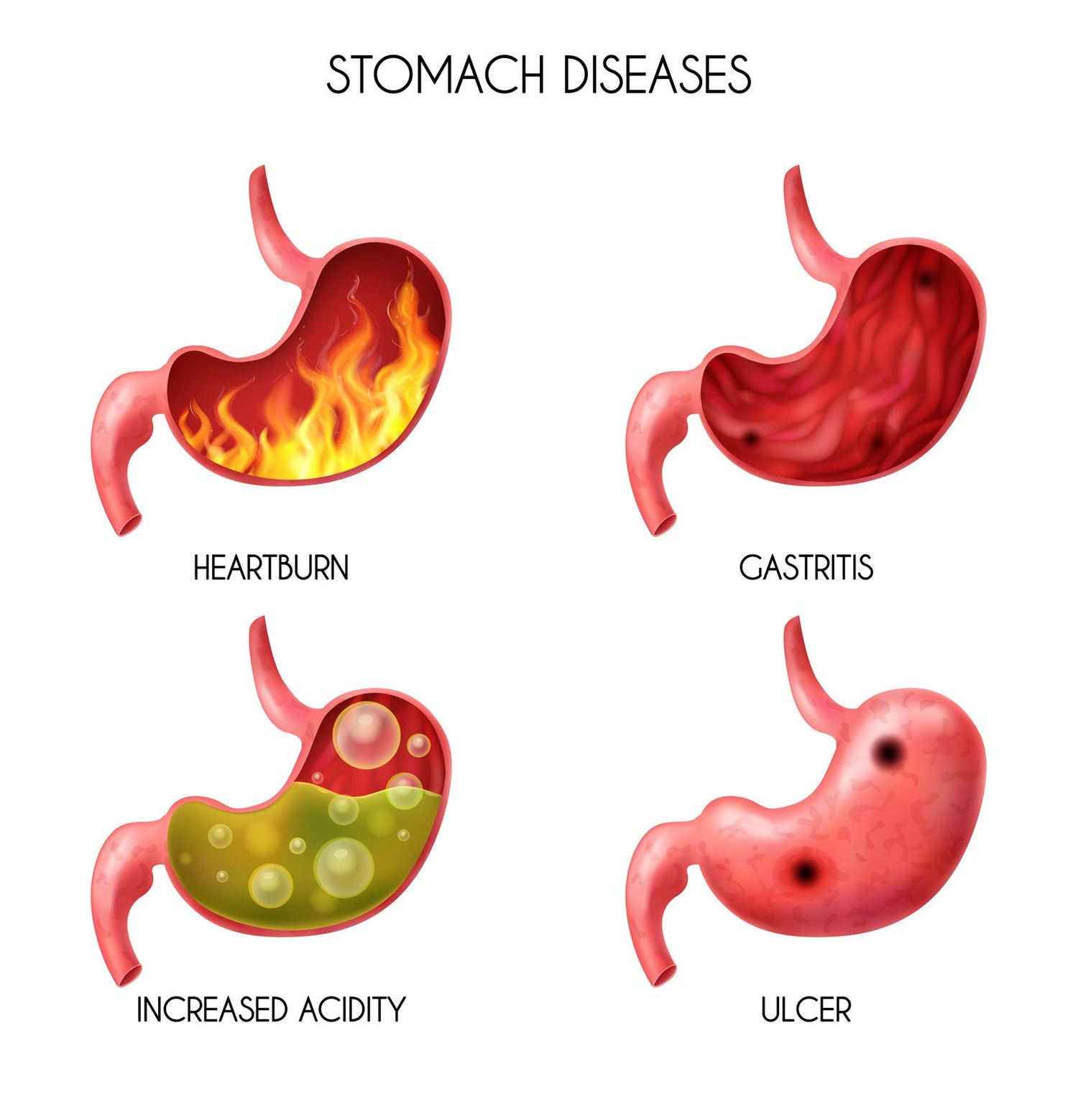 Stomach Diseases